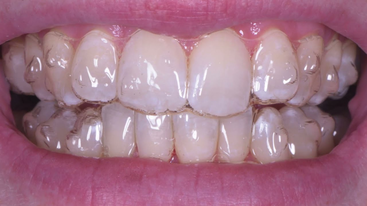 Invisalign fit appointment