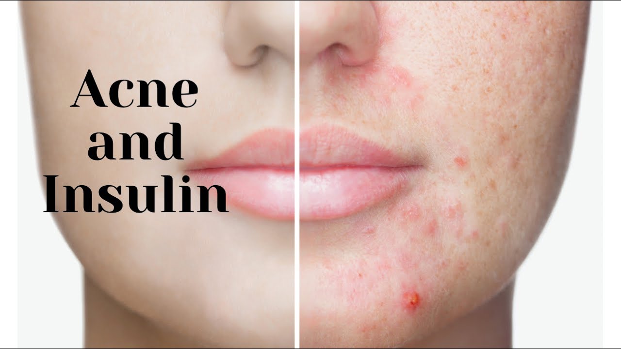 Acne and Insulin