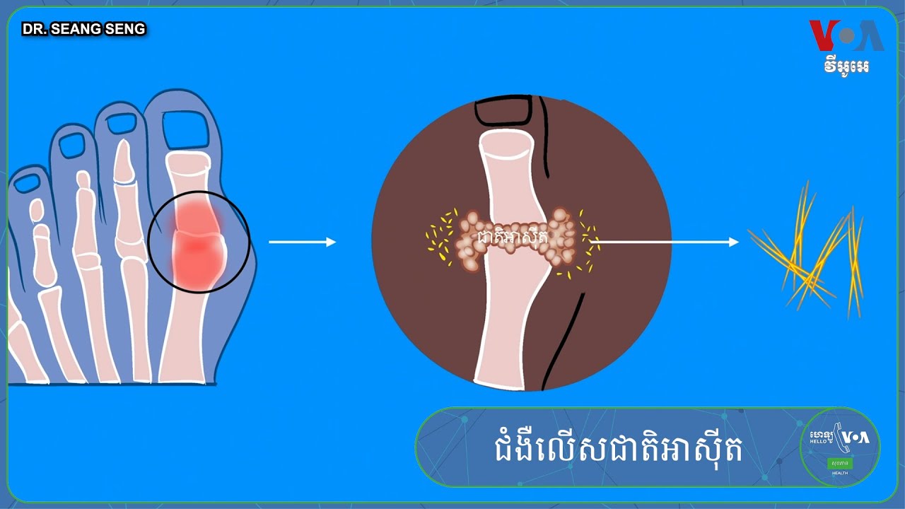 ជំងឺ​លើស​ជាតិ​អាស៊ីត​អាច​សម្ងំ​នៅ​ក្នុង​ខ្លួន​យើង​រាប់​ឆ្នាំ​ទម្រាំ​ដឹង​ថា​មាន​ជំងឺ​នេះ