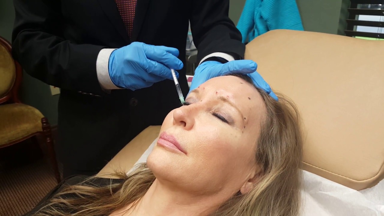 BOTOX Cosmetic Procedure for Glabella Lines and Crow's Feet