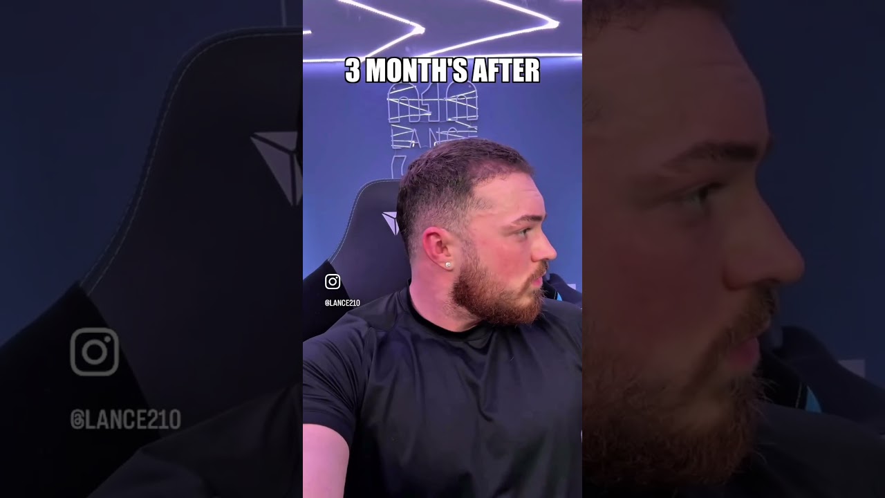 Lance Stewart Before & After 6 Month FUE Hair Transformation #beforeandafter  #lafuehairclinic