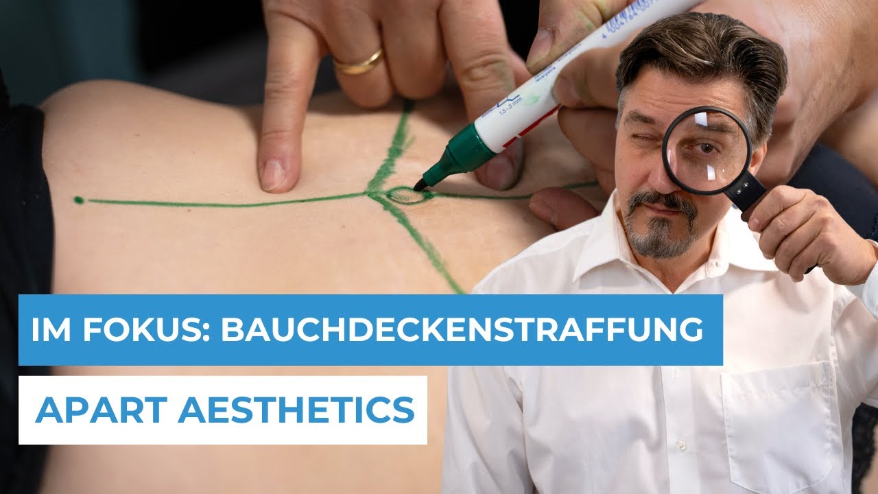 APART AESTHETICS - IM FOKUS: Bauchdeckenstraffung