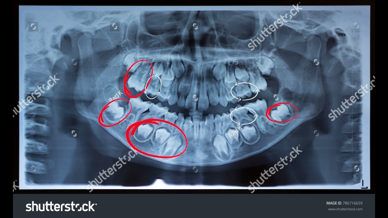 Regrowth of Lost Adult Teeth!