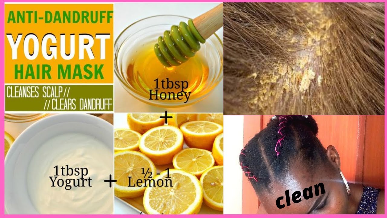 Anti-Dandruff Home Remedies// Reduce scalp scratching with this Hair Mask//Goddess Naturals.