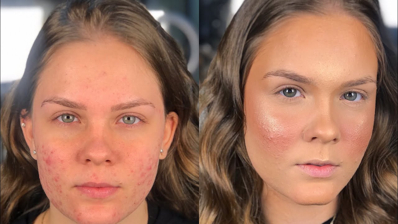 PREPARA&Ccedil;&Atilde;O DE PELE COM ESPINHAS/ACNE - Maquiando Cliente