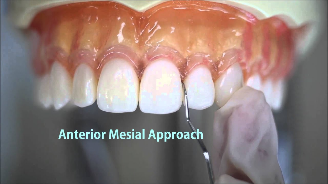 How to use Dental Explorer 11-12(익스플로러 11-12 사용법)