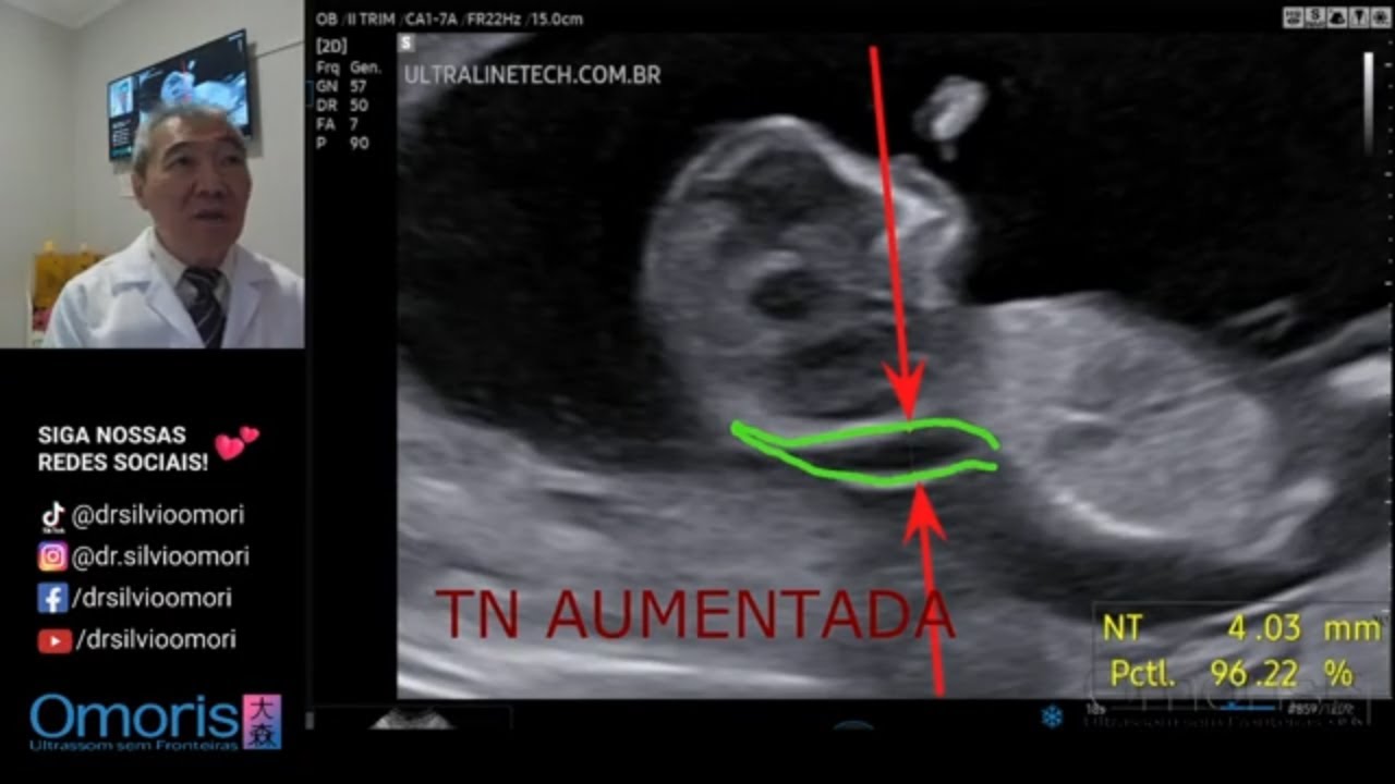 TRANSLUCÊNCIA NUCAL aumentada!