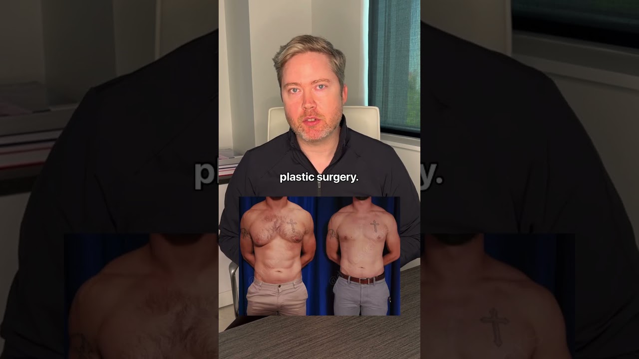 Gynecomastia Surgery for Men