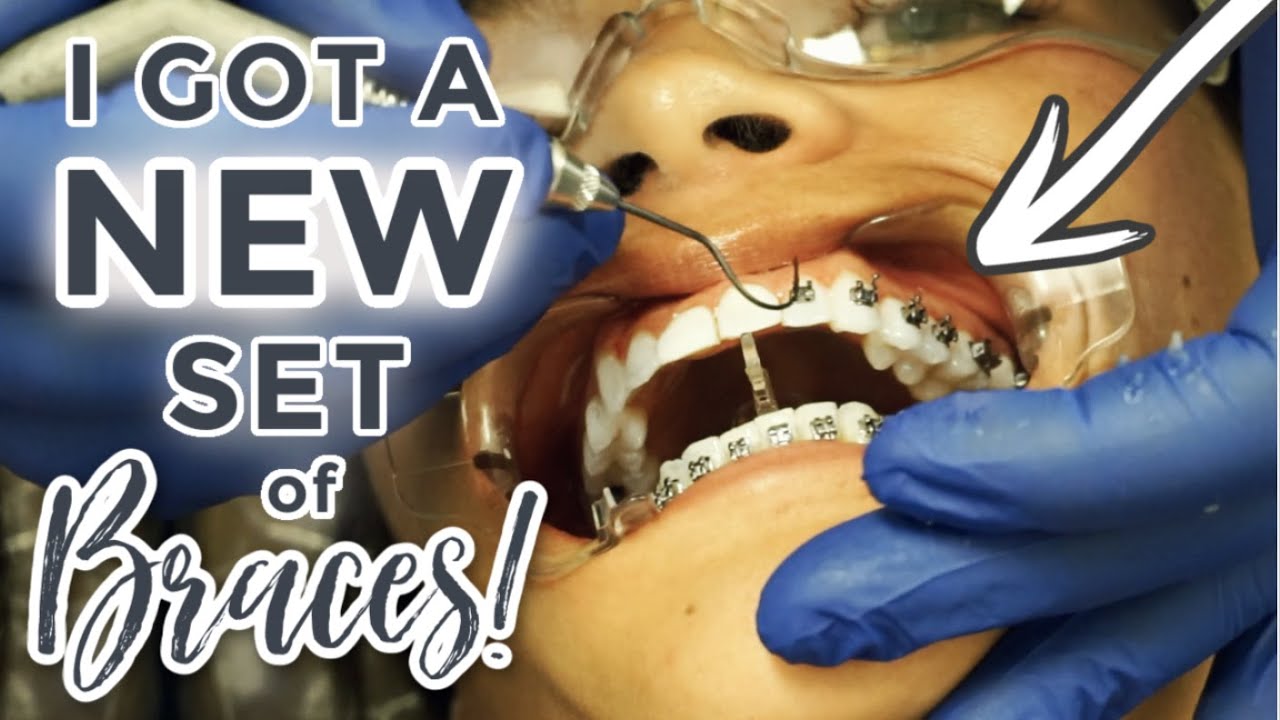 2 YEAR BRACES UPDATE VLOG! | GETTING A BRAND NEW SET OF BRACES