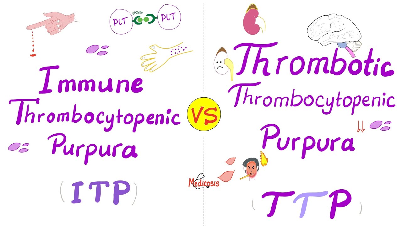 ITP vs TTP (immunologiczna plamica małopłytkowa vs zakrzepowa plamica teombocytopeniczna)