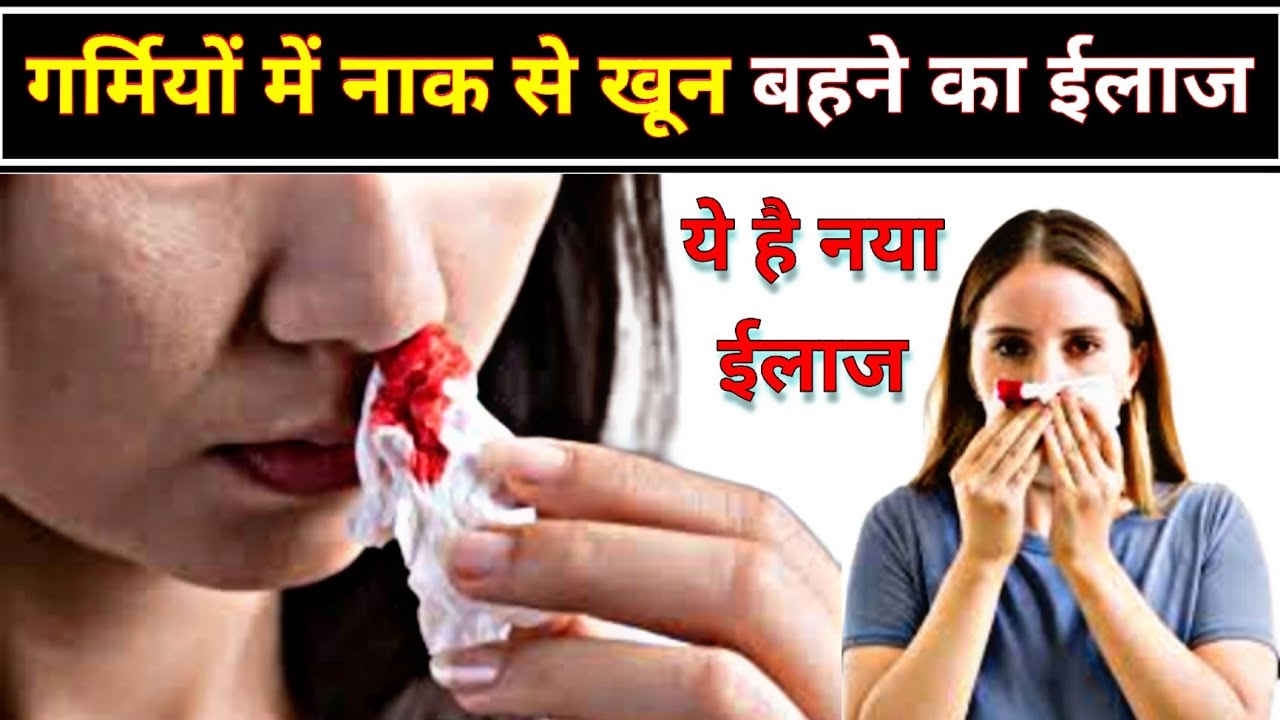 गर्मियों में नाक से खून बहने का बेस्ट ईलाज // Epistaxis treatment in Hindi // nose bleeding