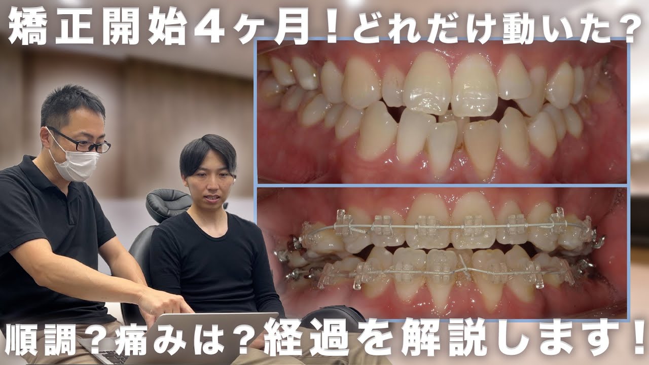 【矯正密着EP4】出っ歯/開口で悩む患者様。4ヶ月目の変化を解説！【矯正体験談】