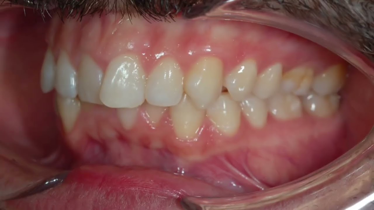 Invisalign Treatment for Crowded Teeth | Fast Smile Improvement 