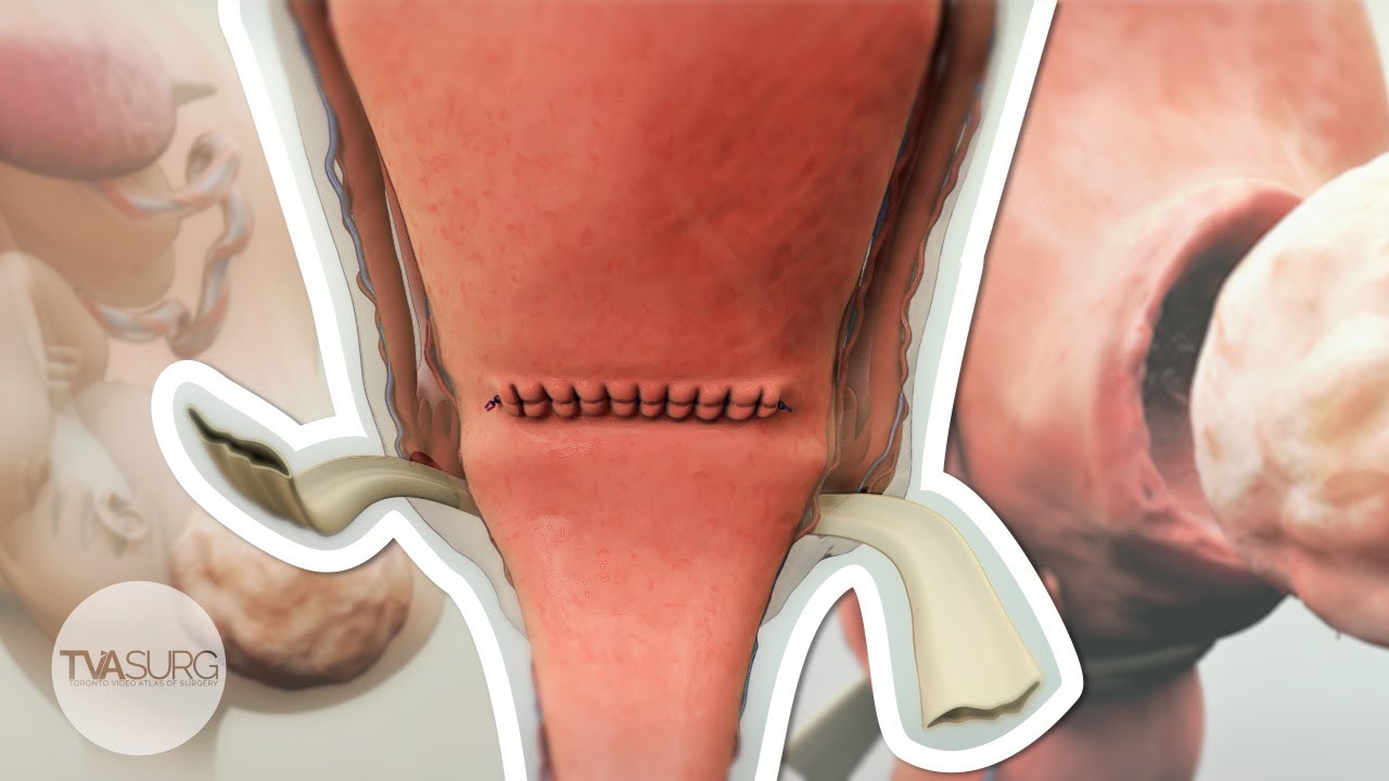 Cesarean Myomectomy | TVASurg