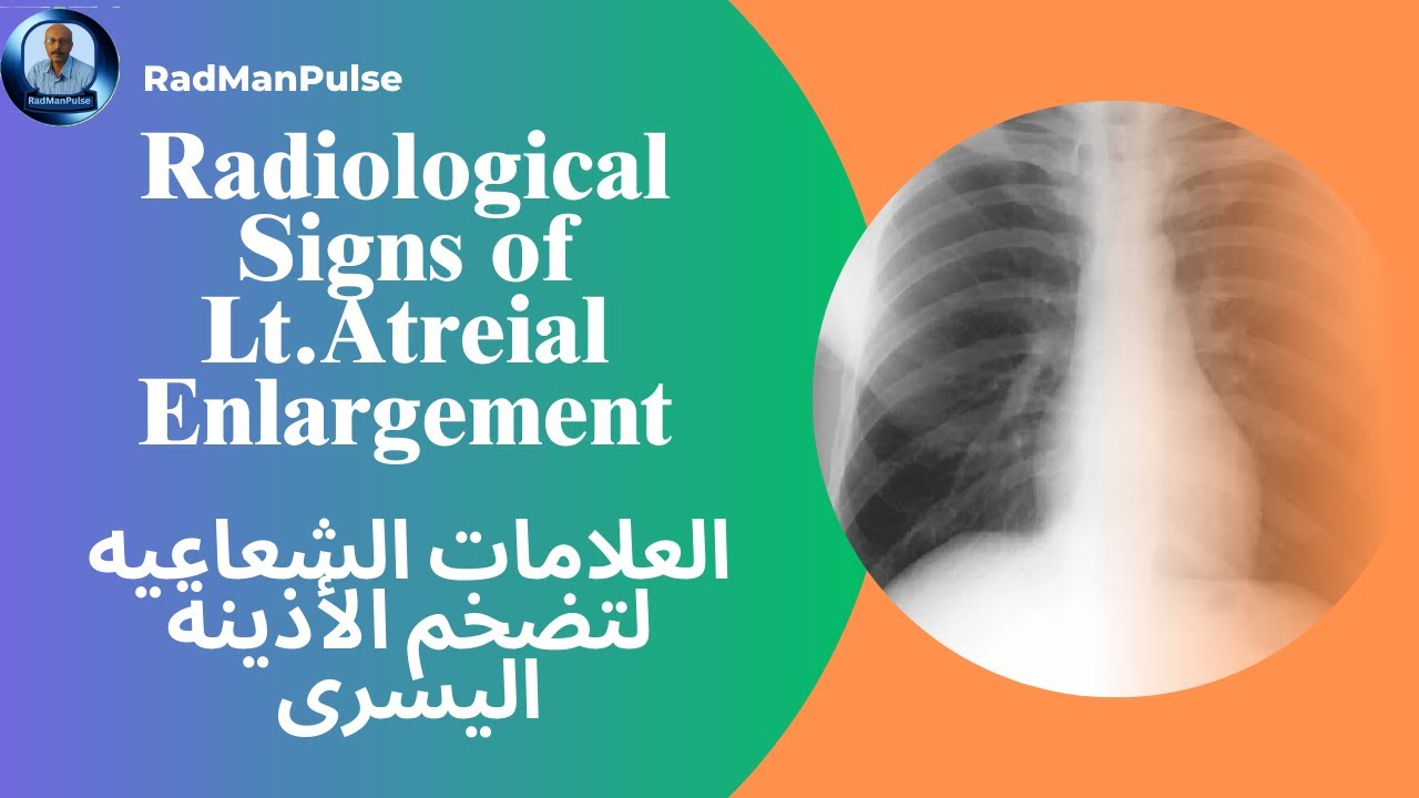 العلامات الشعاعية لتضخم الأذينة اليسرى  Radiological Signs of Left atreial Enlargement