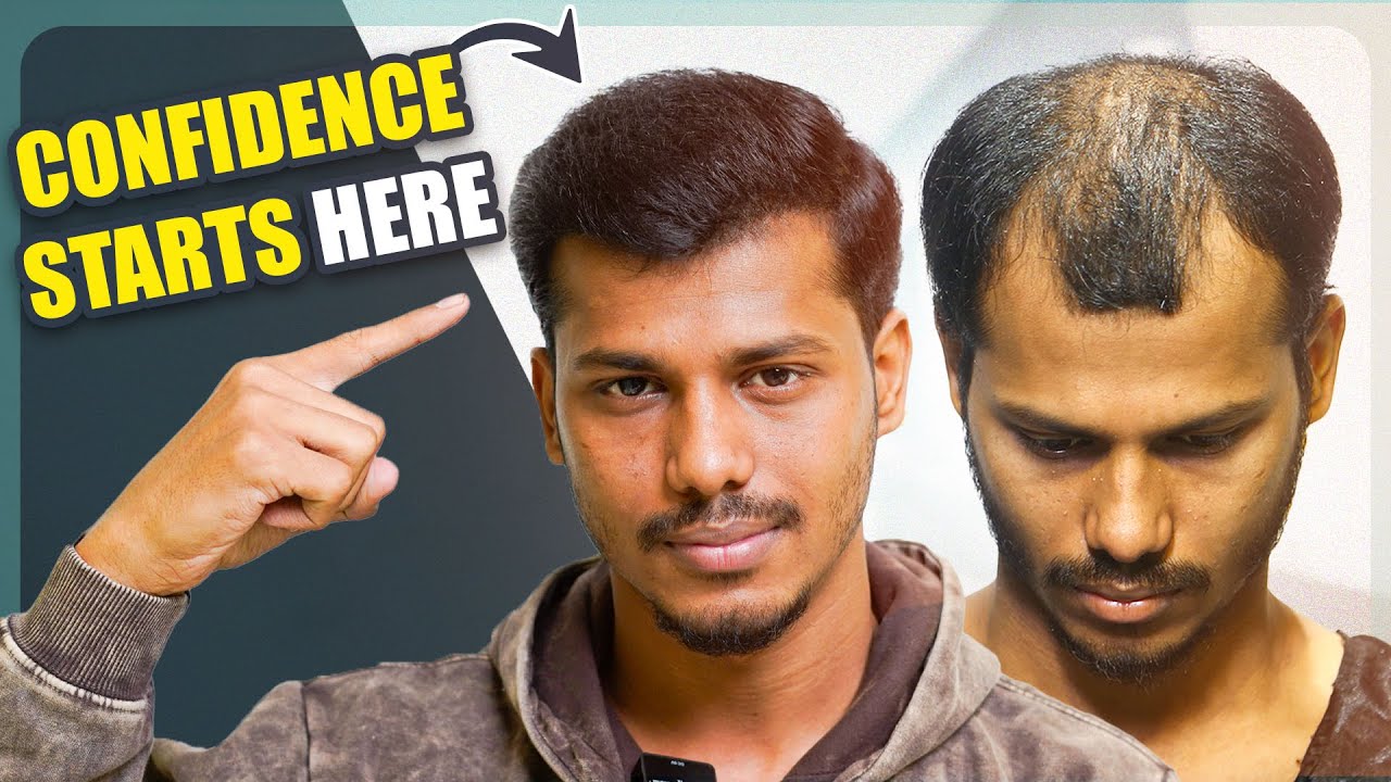 See the Amazing 4-Month Results 😍 | Hair Transplant in Kolkata | New Roots