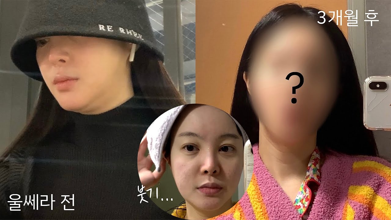 생에 첫 울쎄라…시술 전, 후 3개월간의 솔직 후기🏥 [ 병원 고르는법, 붓기 케어, 추천? 비추천? ]  | SAEYAN 새얀