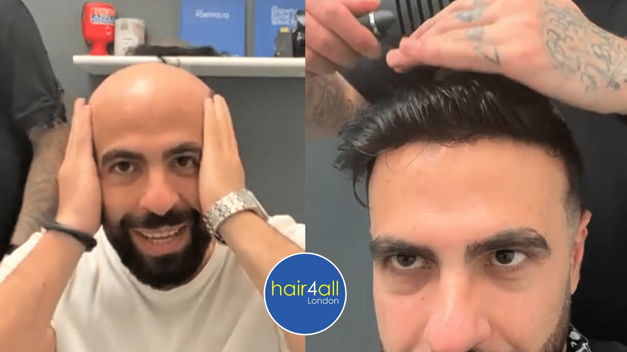 Before & After | Hair System | Non-Surgical Hair Replacement System Men/Women | UK/USA/International