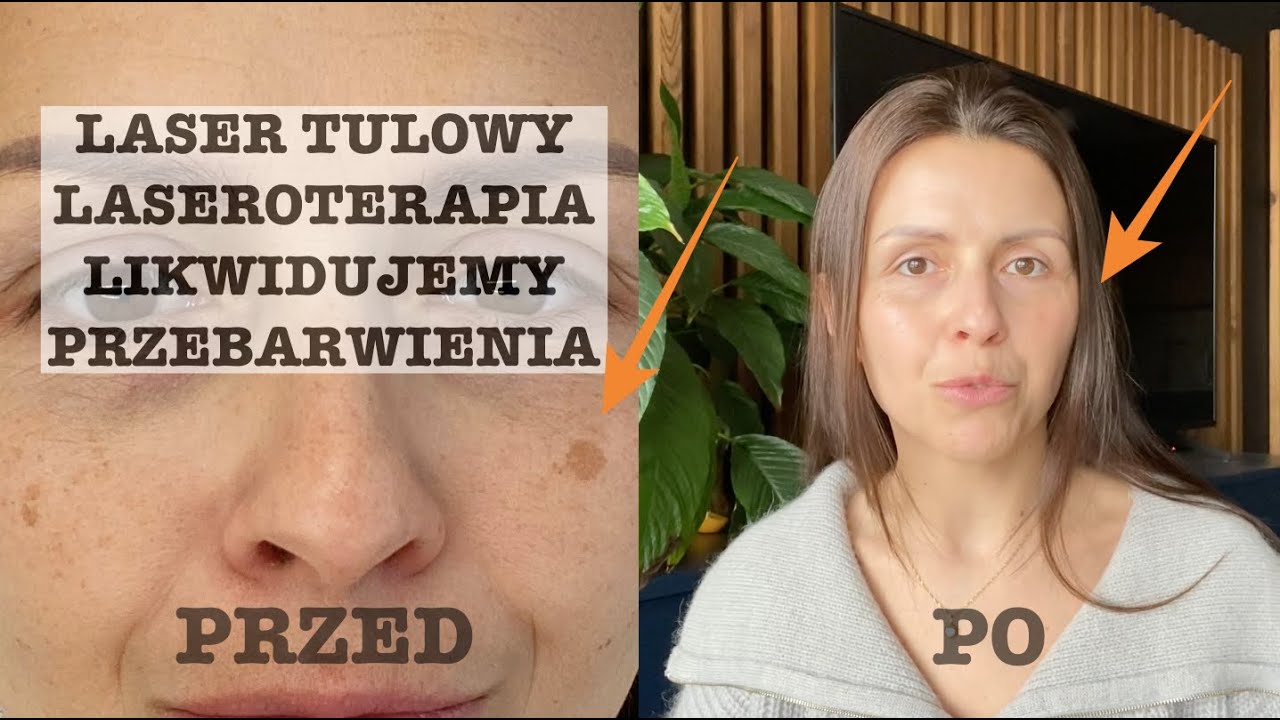 LASER TULOWY / REDUKCJA PRZEBARWIEŃ / PRZED I PO
