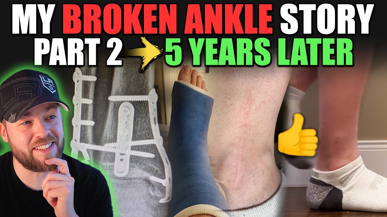My Broken Ankle Story: Part II - 5 Years Later (Trimalleolar Fracture)