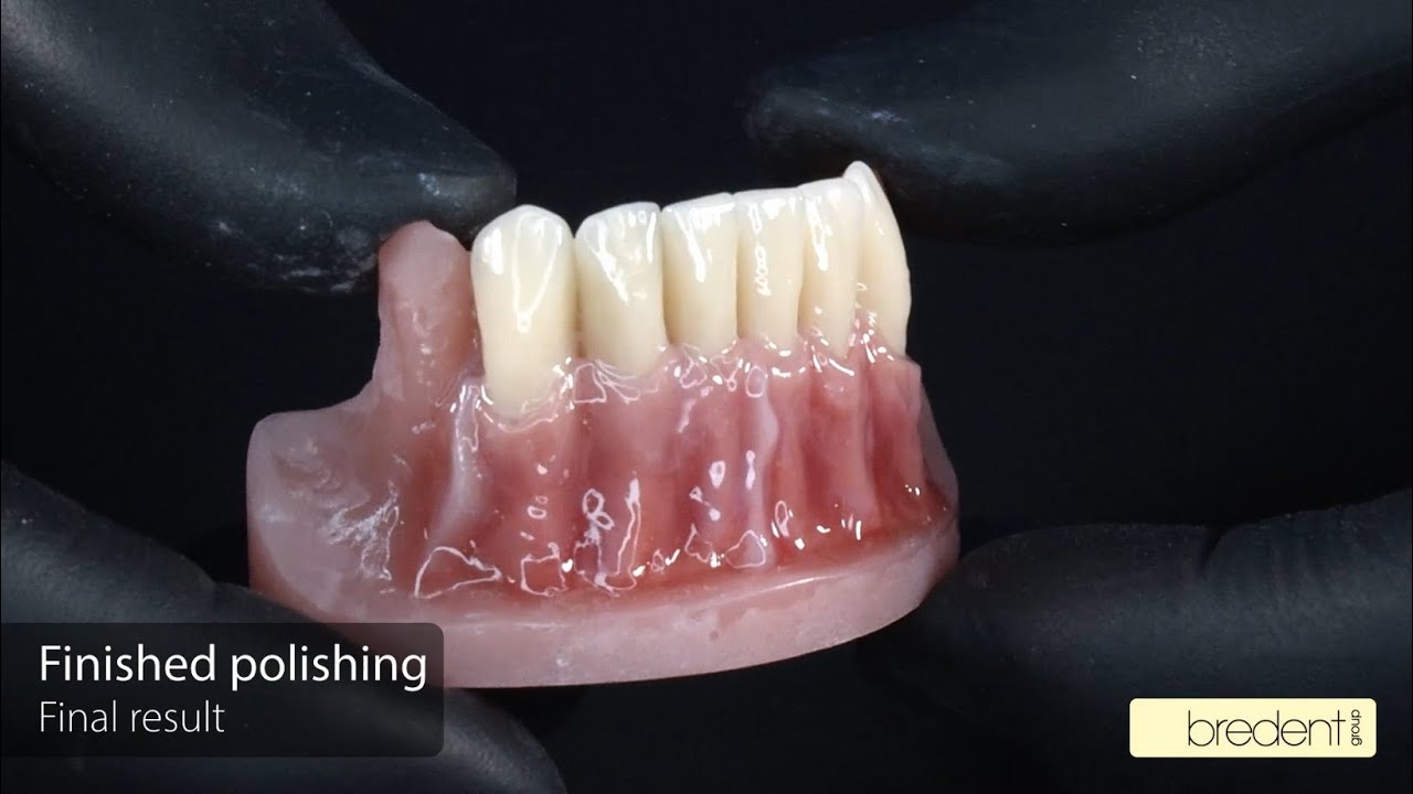 Brilliant high-glaze polishing of crea.lign GUM composites.