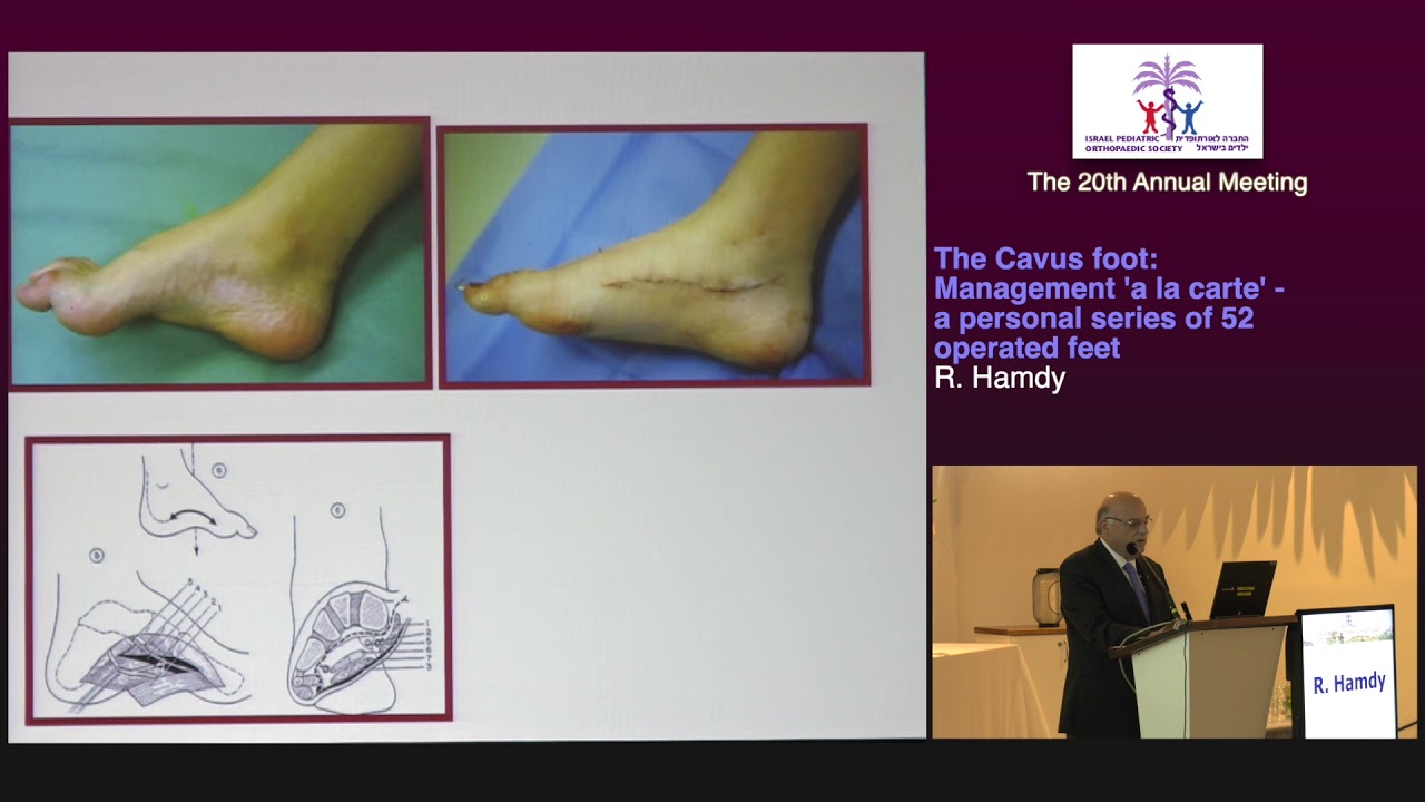 Day 2 - 9 - The Cavus Foot: management ’a la carte‘