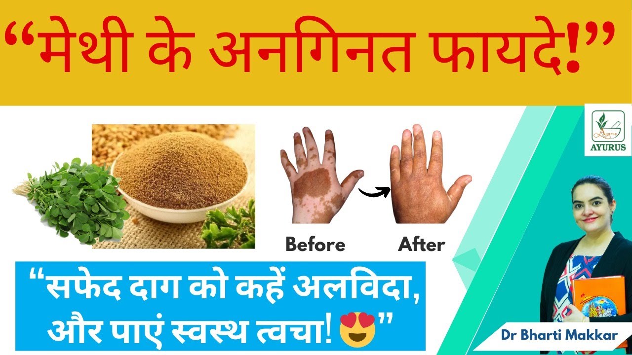 How Fenugreek Supports Vitiligo Recovery | Ayurvedic Diet Insight By Dr. Bharti Makkar