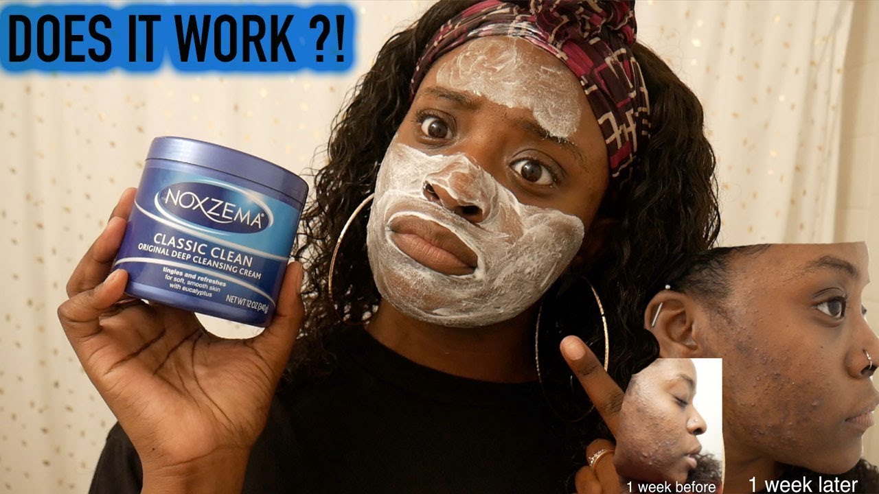 #30DayNoxzemaChallenge l 1 WEEK UPDATE !!! ( ACNE PRONE SKIN)
