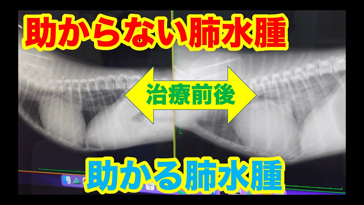 助かる肺水腫と助からない肺水腫