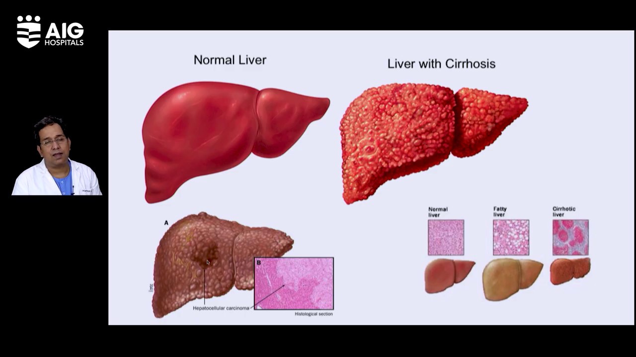 Liver Cirrhosis: Common Precautions in Assamese | Dr. Mithun Sharma | AIG Hospitals