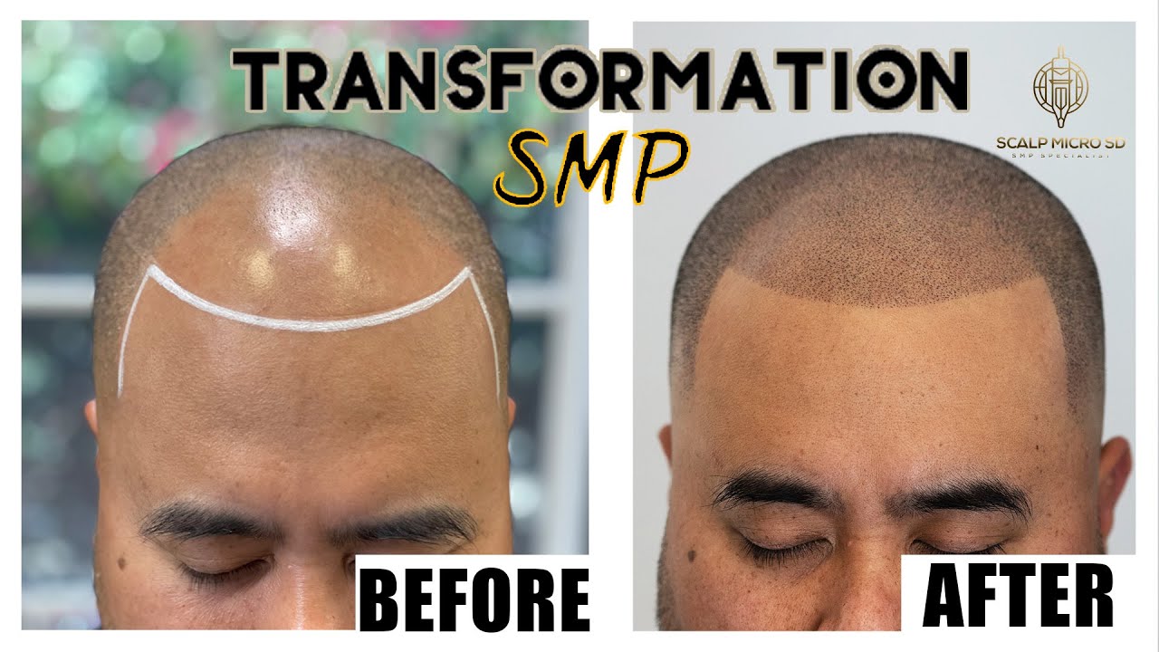 SMP TRANSFORMATION - Full Procedure Start to Finish | LIFE CHANGING!!!