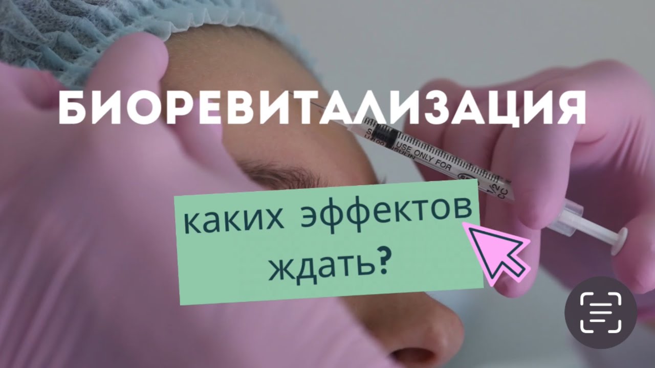Биоревитализация. Каких эффектов ждать от процедуры.