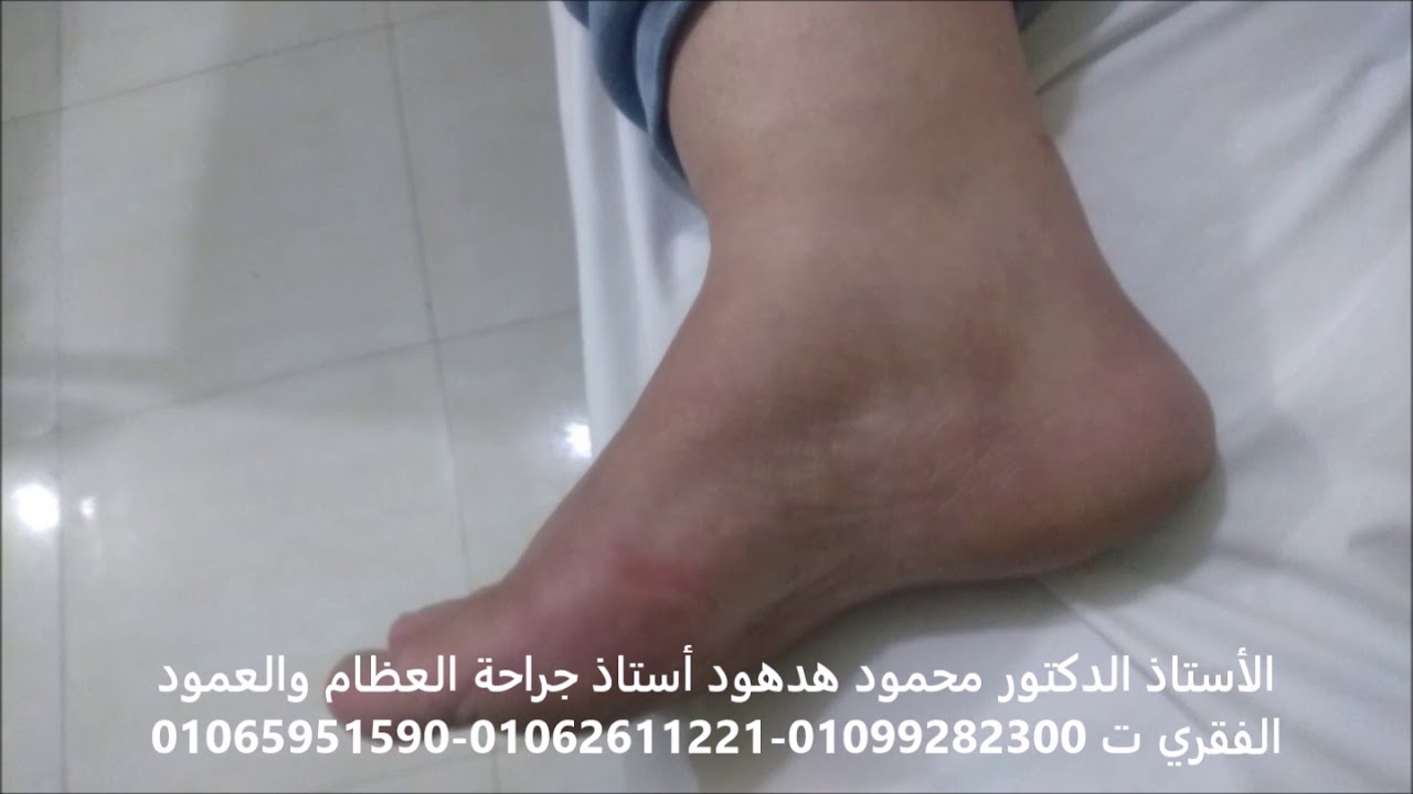 نتائج عمليات  الكعب  والشوكة  العظمية  بعد  4 سنوات  plantar Fascia  release