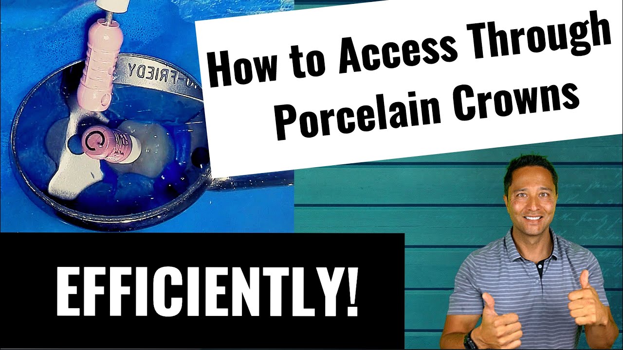 Root Canal Through a New Porcelain Crown (Wave One Gold)
