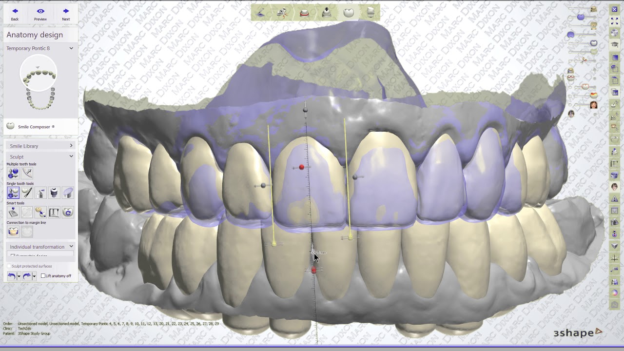 3Shape Traditional Diagnostic Wax-up from Trios Scan