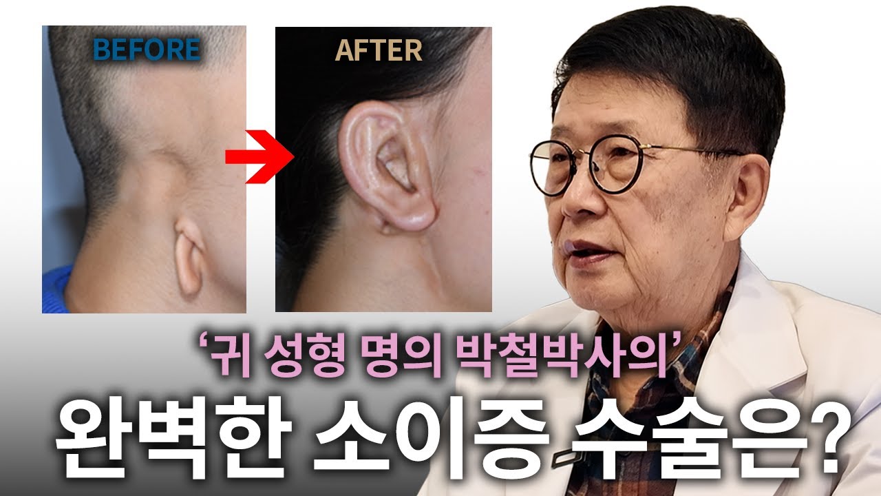 30년 이상 경력의 명의가 밝히는 소이증 수술 실패하지 않는 법