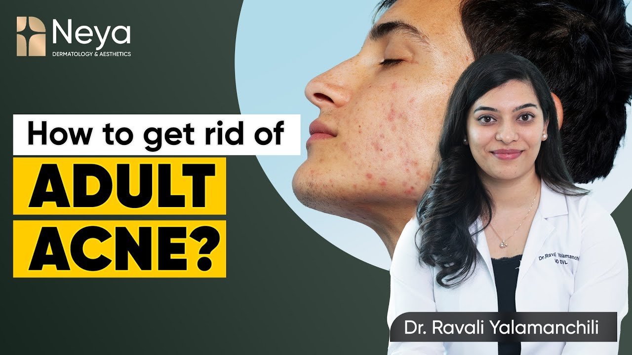 Adult Acne treatment | Neya clinic | Acne treatment in hyderabad