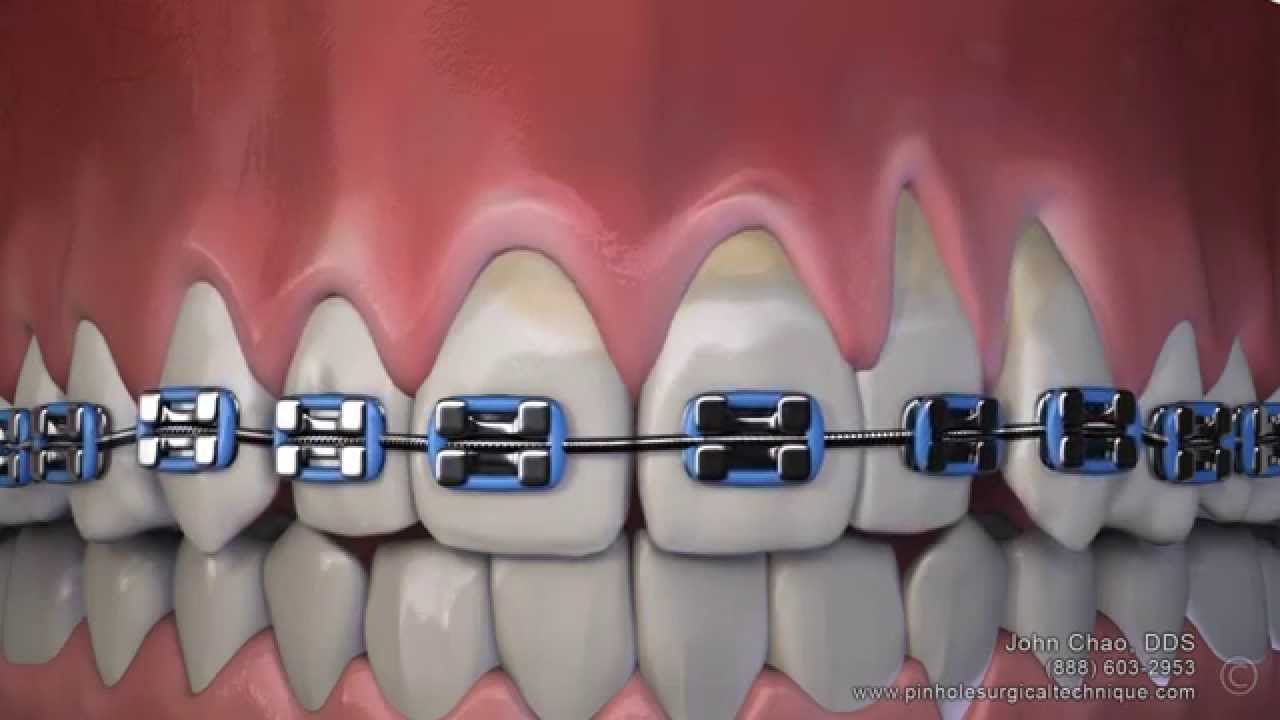 Gum Recession After Wearing Braces Can Now Be Treated Without Gum Grafting Surgery
