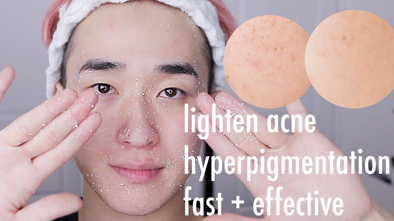 How I fade ACNE scars FAST! Easy Routine 2017