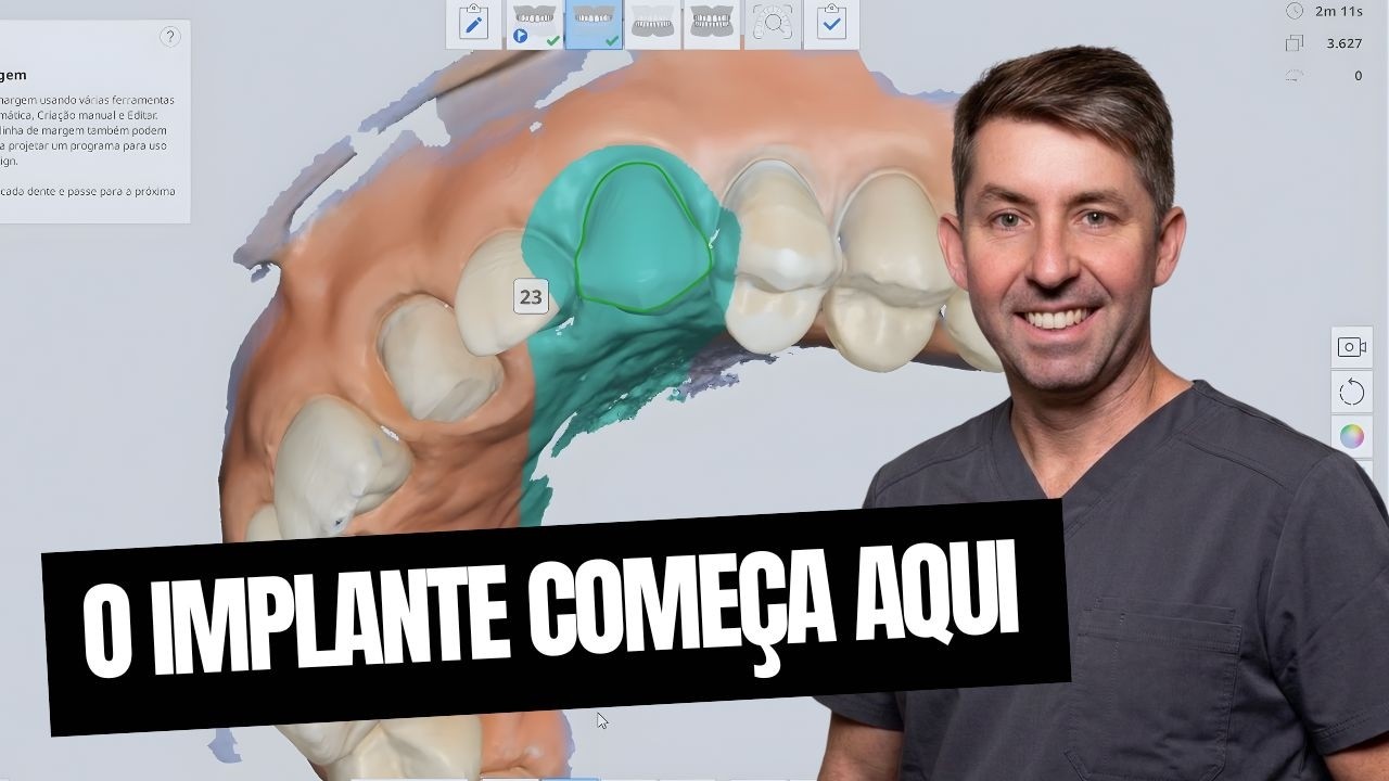 Fluxo digital na odontologia: enceramento diagnóstico para planejamento de implantes.