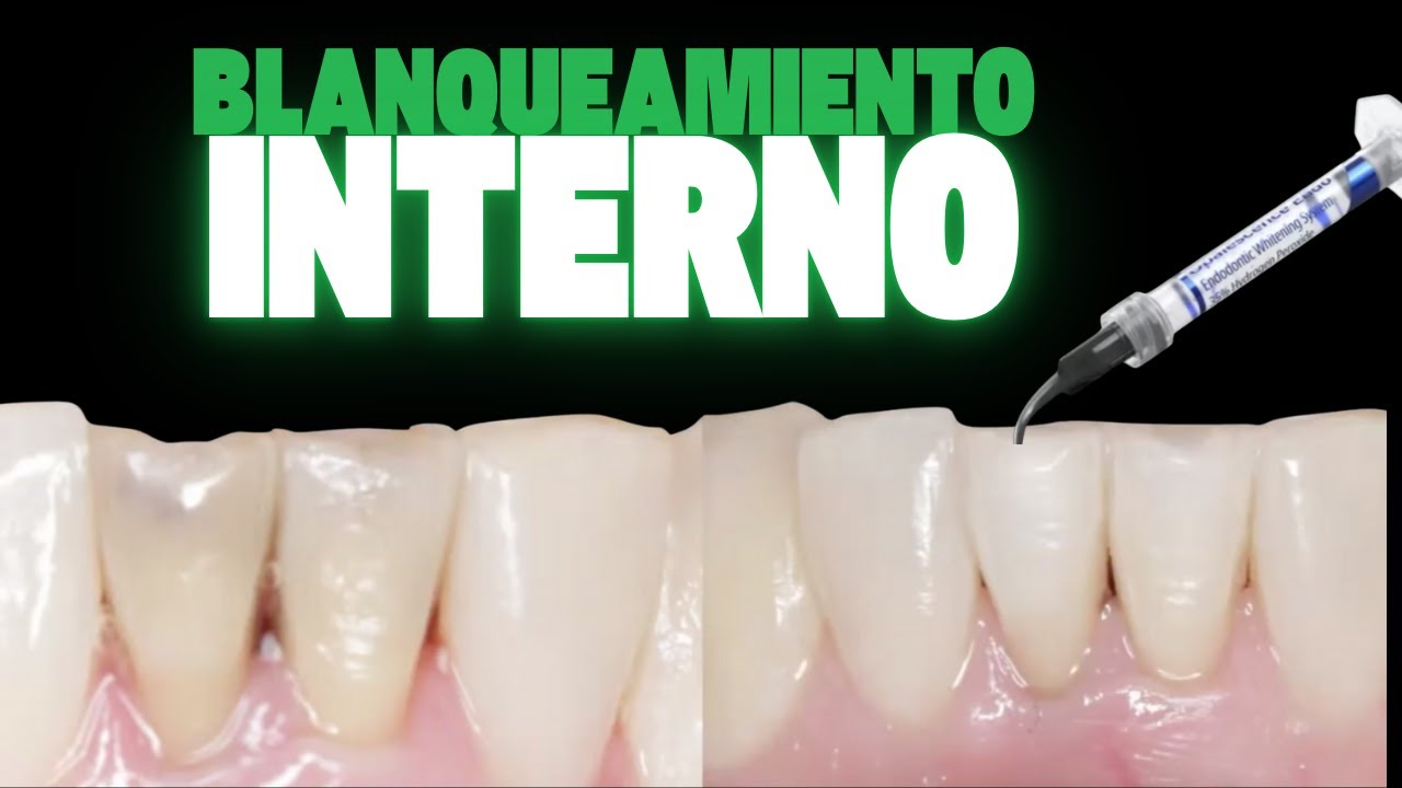 Blanqueamiento interno 🦷