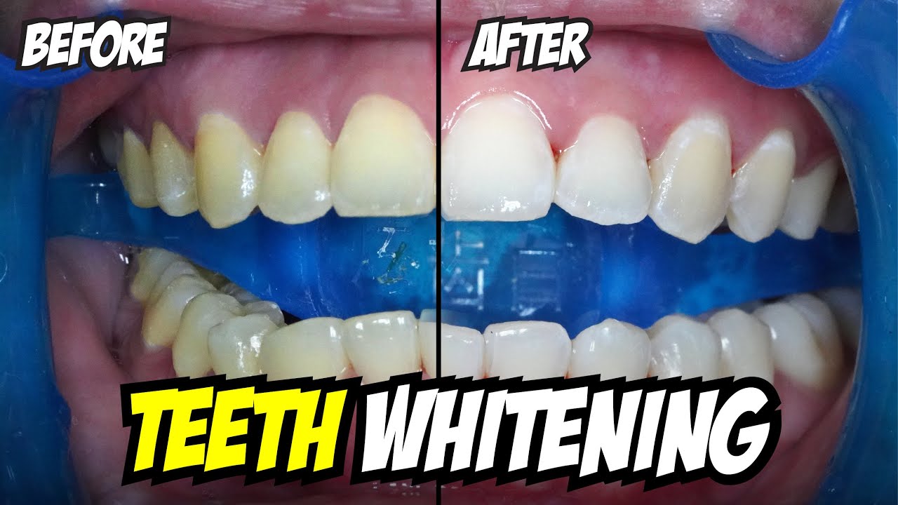 BLEACHING | Teeth Whitening At The Dentist | Dentist | Dokter Gigi Tri Putra