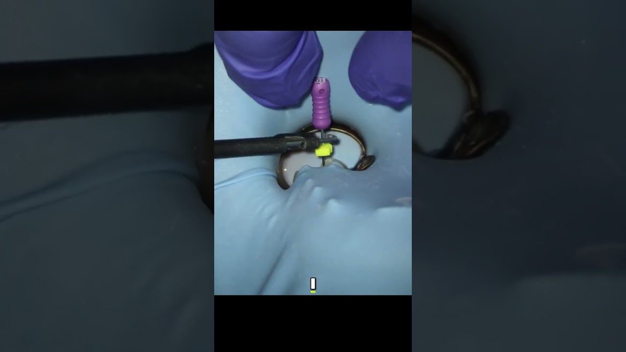 Dental Glide Path  Easy Canal Shaping