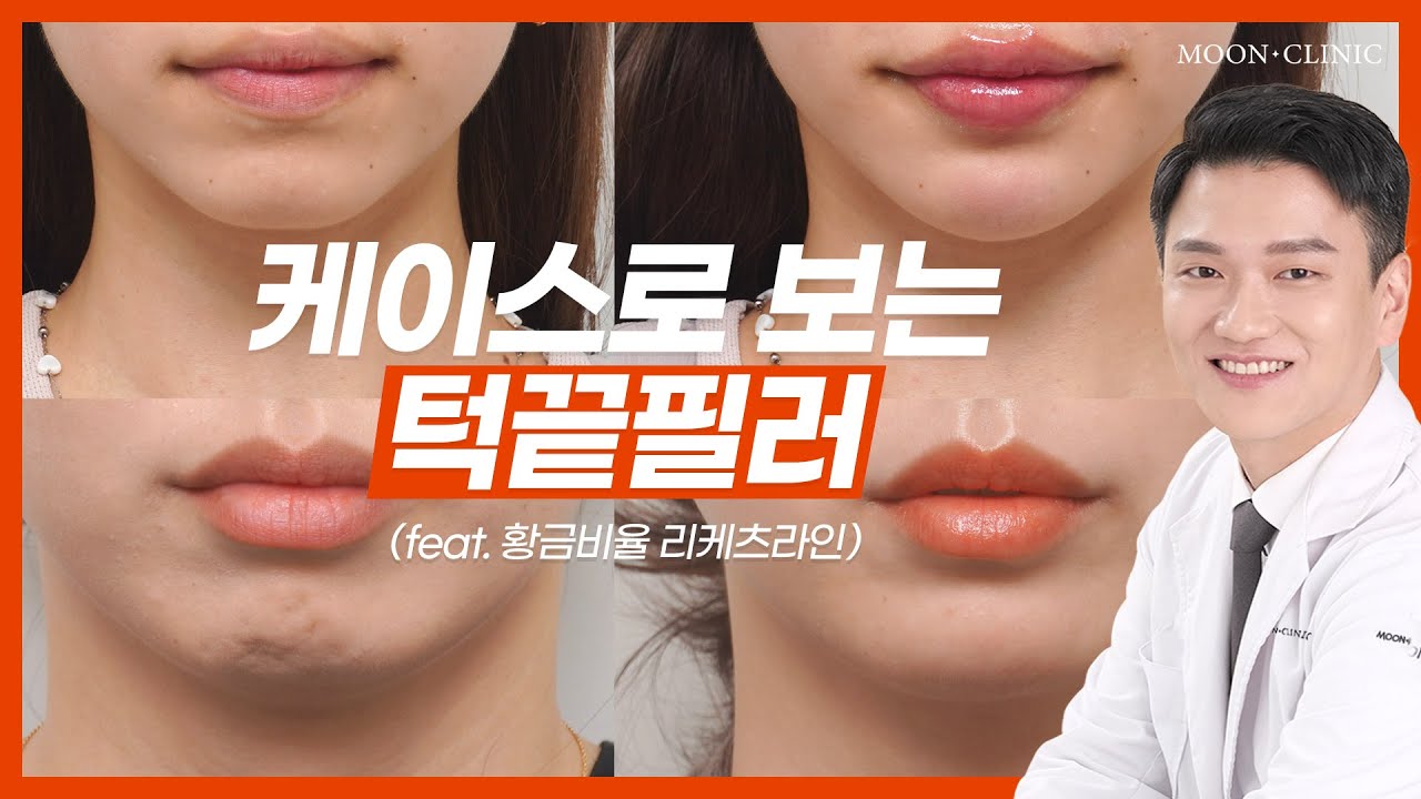나한테 맞는 턱 필러 시술 방법은? (feat 무턱, 자갈턱)[JPN]