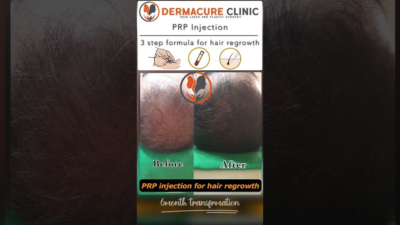 Experience the wonder of PRP injection | 3step formula for hair regrowth & anti hair fall treatment