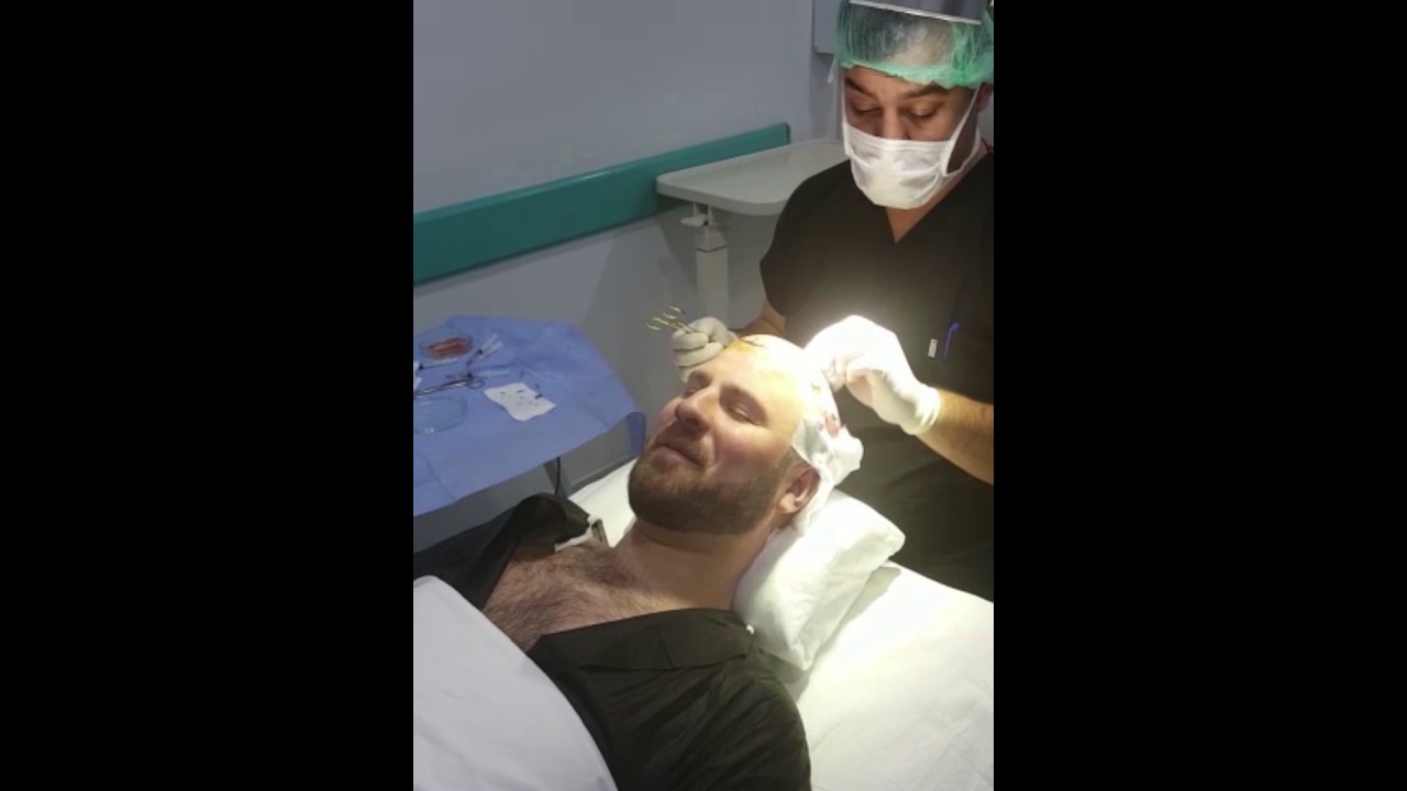 Sebastian Teso - Trasplante Capilar - Resultado de 0 a 3 meses
