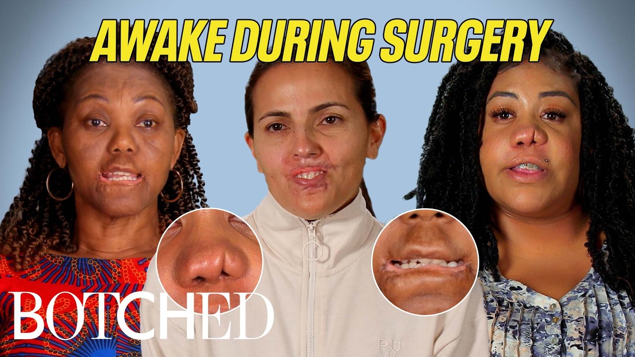 Wide Awake Under The Knife: Infected Lip Filler, Chemical Burn and More (Compilation) | Botched | E!