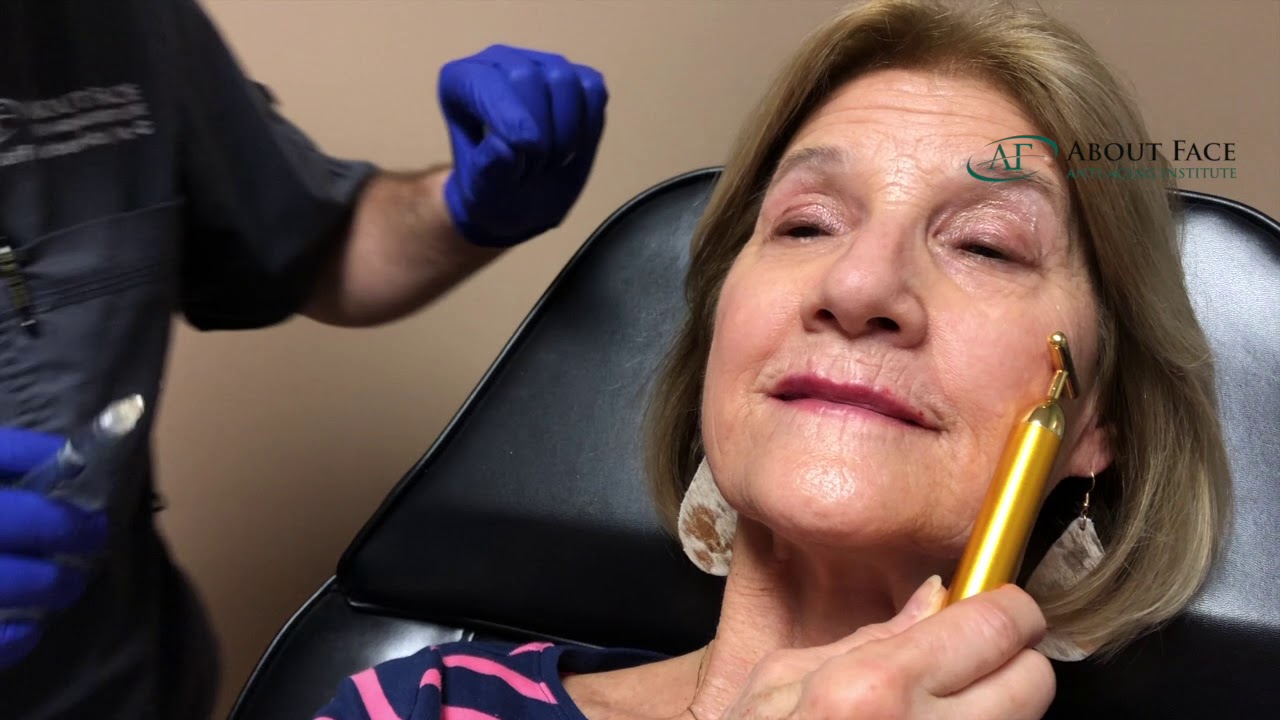 Volbella, Juvederm Ultra Video