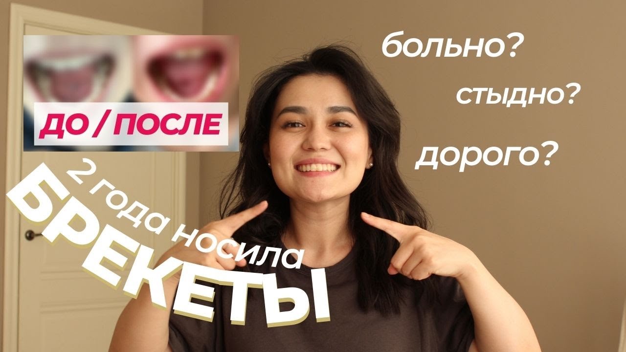 ПОСМОТРИ прежде, чем ставить брекеты | ДО И ПОСЛЕ, мой опыт, история, советы