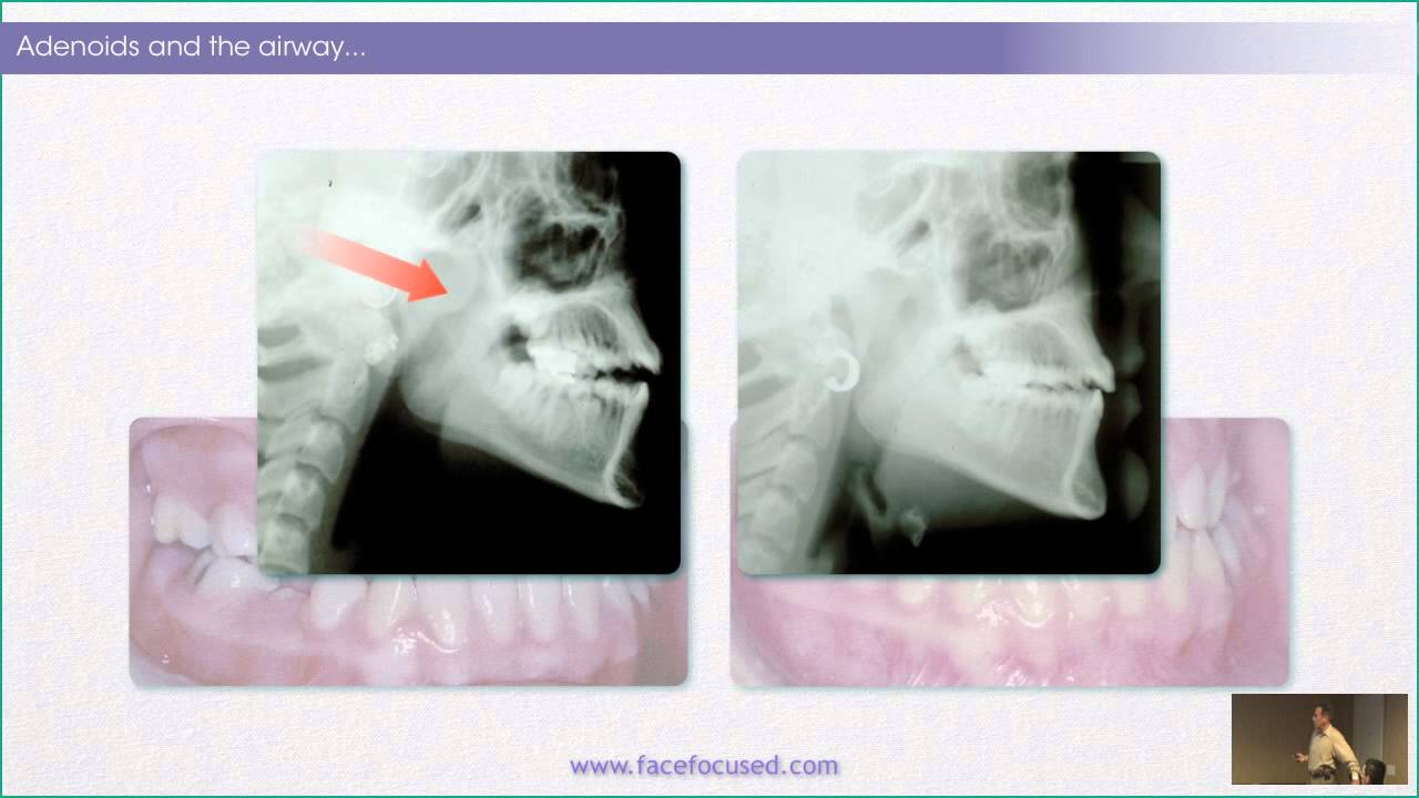 The Case for Rewards of Correcting Rest Oral Posture - William M. Hang, DDS, MSD